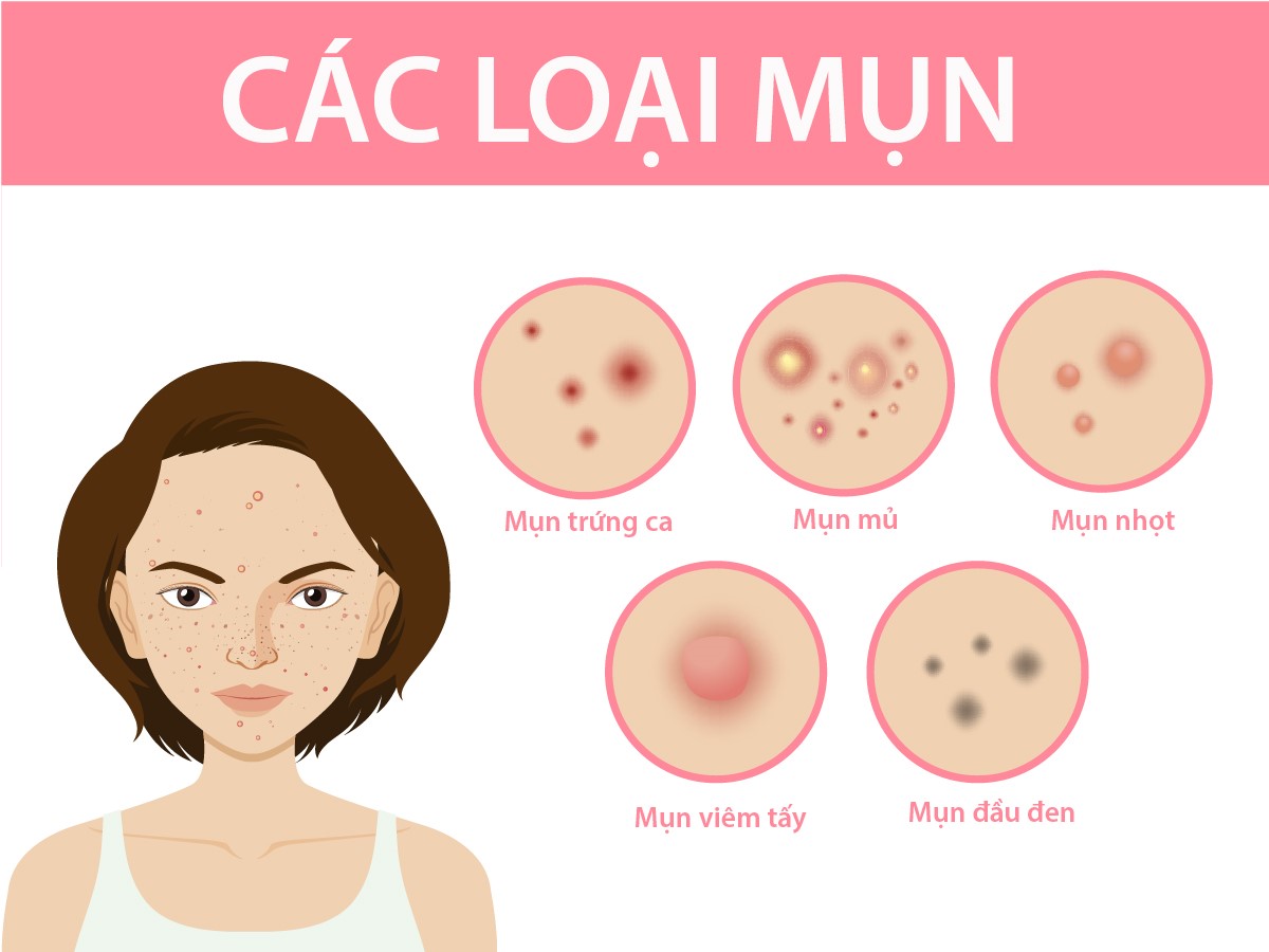Các loại mụn phổ biến thường gặp